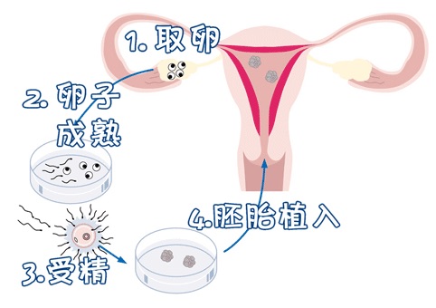 关于供卵包男孩正规代生公司